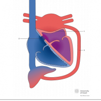 Cor triatriatum sinister with complete membrane and hemiazygos vein and atrial septal defect (ASD)