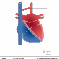 Partial cor triatriatum sinister with partial pulmonary vein connection