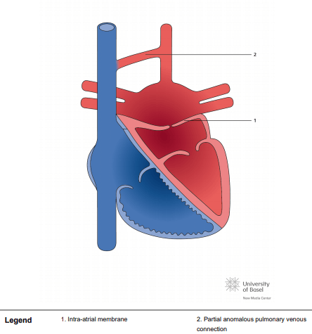 Cor triatriatum sinister with partial anomalius pulmonary vein connection