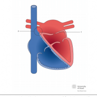 Cor triatriatum sinister with superior sinus venosus defect