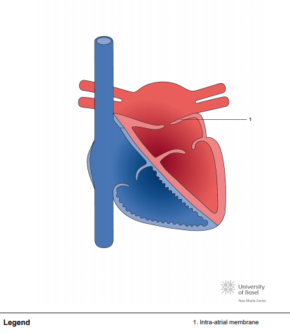 Cor triatriatum sinister