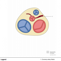 Coronary artery fistula congenital