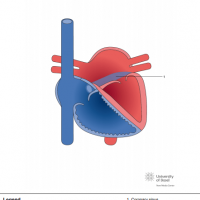 Unroofed coronary sinus