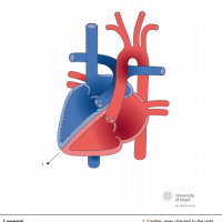 Dextrocardia