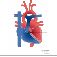 Doubly committed ventricular septal defect (VSD)