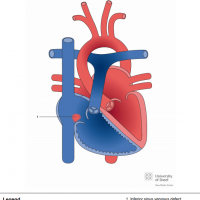 Inferior sinus venosus defect (SVD)