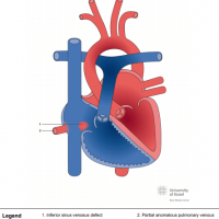 Inferior sinus venosus defect (SVD) with partial anomalous pulmonary venous connection (PAPVC)