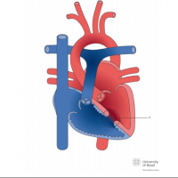 Muscular ventricular septal defect (VSD)