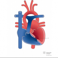 Muscular ventricular septal defect (VSD) with left ventricular dilatation