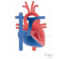 Parachute mitral valve with mitral stenosis