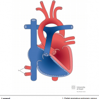 Partial anomalous pulmonary venous connection (PAPVC) to inferior caval vein (IVC)