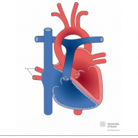 Partial anomalous pulmonary venous connection (PAPVC) to right atrium