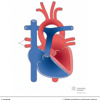Partial anomalous pulmonary venous connection (PAPVC) to superior caval vein (SVC)