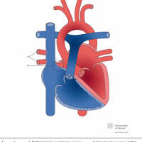 Partial anomalous pulmonary venous connection (PAPVC) with superior sinus venosus defect