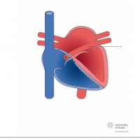 Partial anomalous pulmonary venous connection of left lower pulmonary vein to right atrium