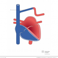 Partial anomalous pulmonary venous connection of left upper pulmonary vein