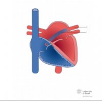 Partial anomalous pulmonary venous connection of left upper pulmonary vein to coronary sinus