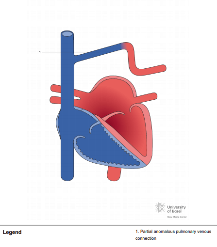 Partial anomalous pulmonary venous connection of left upper pulmonary vein