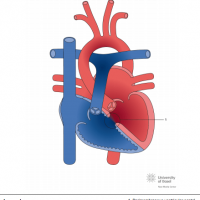 Perimembranous ventricular septal defect (VSD) with ventricular dilatation