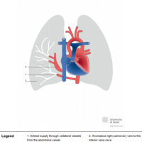 Scimitar syndrome