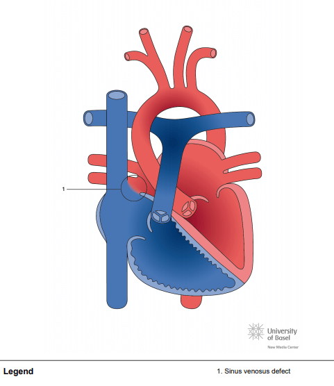 Superior sinus venosus defect (SVD)