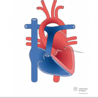 Supravalvular mitral ring with mitral stenosis