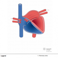 Total anomalous pulmonary venous connection (TAPVC); cardiac type into right atrium (RA)