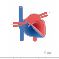 Total anomalous pulmonary venous connection (TAPVC); cardiac type via coronary sinus (CS)