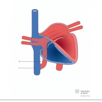 Total anomalous pulmonary venous connection (TAPVC); infradiaphragmatic type