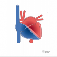 Total anomalous pulmonary venous connection (TAPVC); supracardiac type into superior caval vein (SVC)