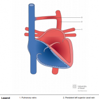 Total anomalous pulmonary venous connection (TAPVC); supracardiac type via inomminate veins