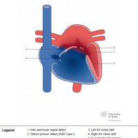 Unbalanced complete atrioventricular septal defect (AVSD) with right dominance
