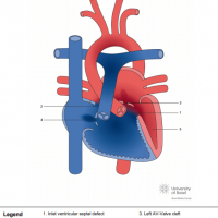 Unbalanced complete atrioventricular septal defect (AVSD) with right dominance