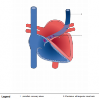 Unroofed coronary sinus with persistent left superior caval vein