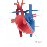 ccTGA with situs inversus, levocardia and pulmonary atresia