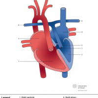ccTGA with situs inversus, levocardia, pulmonary atresia and VSD