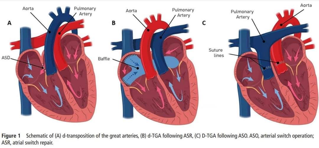 transposition great arteries
