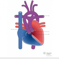 D-Transposition of the great arteries (TGA) with subaortal ventricular septal defect (VSD)
