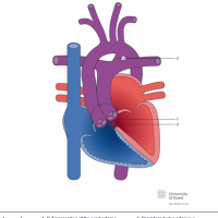 D-Transposition of the great arteries (TGA) with subpulmonar ventricular septal defect (Taussig-Bing)