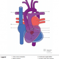 Discordant criss cross AV connection, VSD and double outlet right ventricle (DORV)