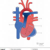 Discordant criss cross AV connection with concordant ventriculo-arterial (VA) connection