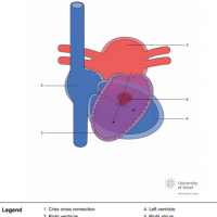 Discordant criss cross AV connection with ventricular septal defect (VSD)