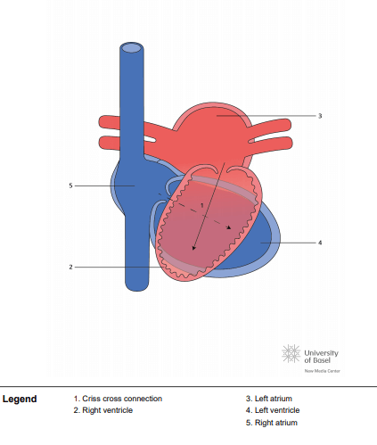 Discordant criss cross AV connection