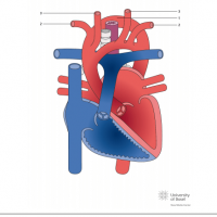 Double aortic arch