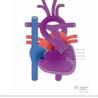 Double inlet left ventricle (DILV) with double outlet right ventricle (DORV) and ventricular septal defect (VSD)