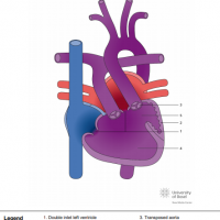 Double inlet left ventricle (DILV) with transposed great arteries (TGA) and ventricular septal defect (VSD)