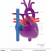 Double inlet left ventricle (DILV) with transposed great arteries (TGA), pulmonary atresia and VSD