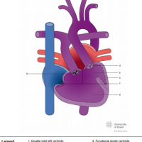 Double inlet left ventricle (DILV) with transposed great arteries (TGA), pulmonary stenosis and VSD