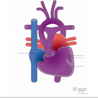 Double inlet right ventricle (DIRV) with double outlet right ventricle (DORV)