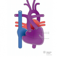 Double inlet right ventricle (DIRV) with ventricular septal defect (VSD)
